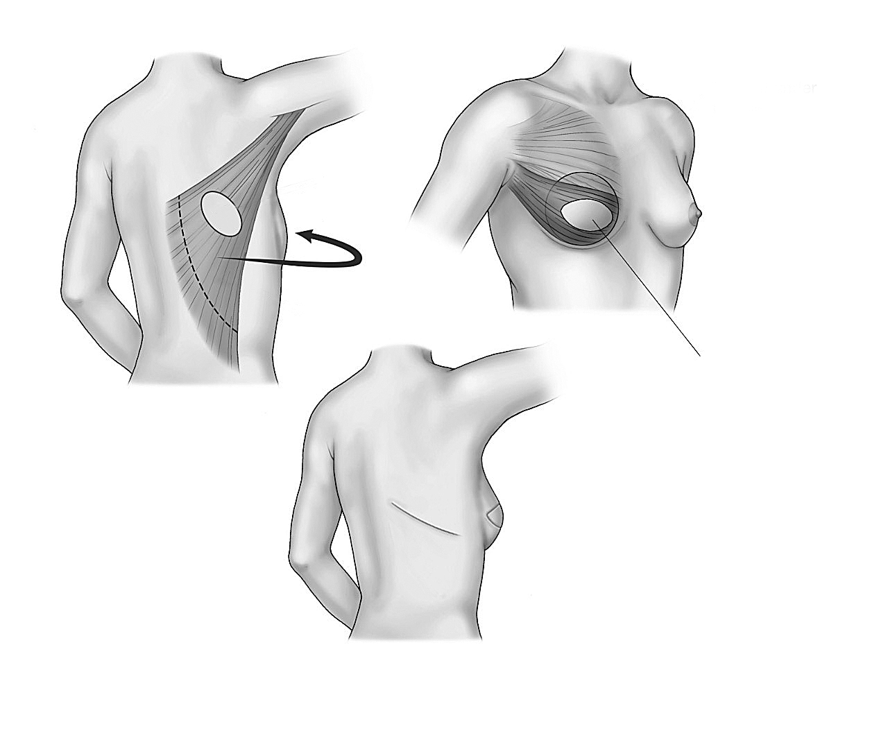 Krūts rekonstrukcija ar lēveri no muguras