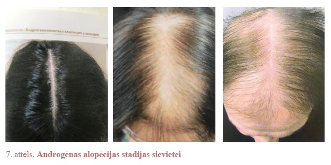 Androgēnās alopēcijas stadijas sievietei