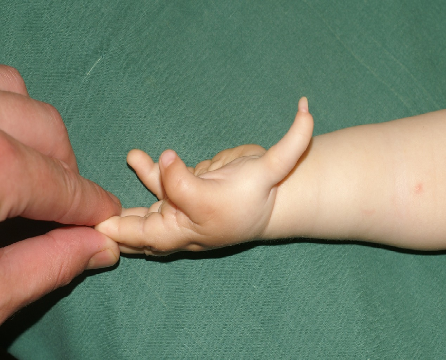 Bērns ar iedzimtu abu plaukstu I pirkstu hipoplāziju un īkšķa duplikatūru kreisajā plaukstā.  