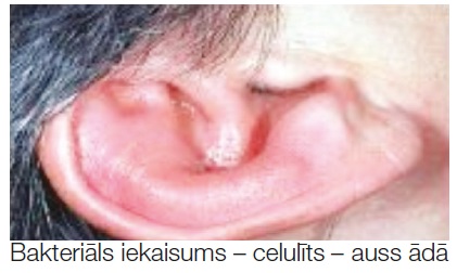 Bakteriāls iekaisums celulīts auss ādā