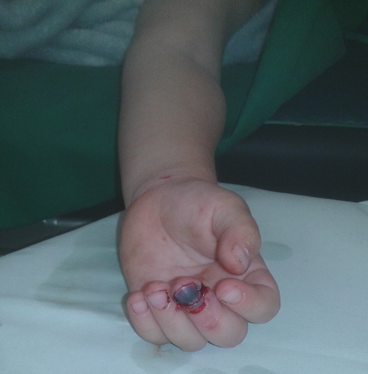 Bilde nr. 1 pacients ar subtotālu pirksta gala amputāciju, saspiežot pirkstu durvīs . 