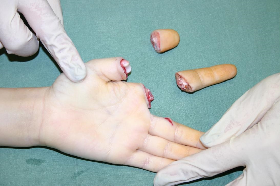 Bilde nr. 4. traumatiska I un II pirkstu amputācija 5 gadus vecam bērnam.