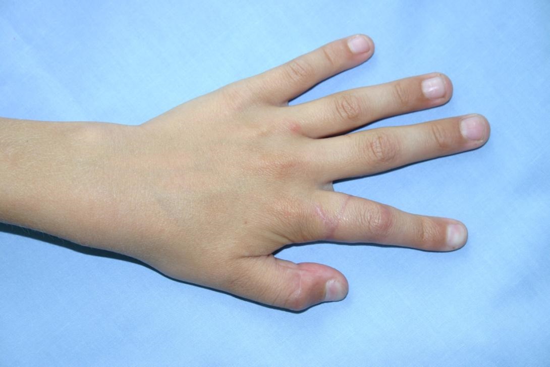Bilde nr. 5. pacients 3 mēnešus pēc I un II pirkstu replantācijas
