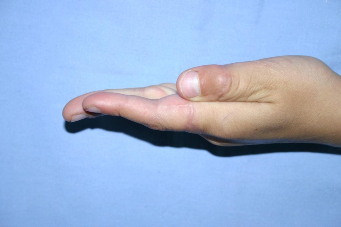 Bilde nr. 6. replantēto pirkstu ekstenzija 3 mēnešus pēc operācijas