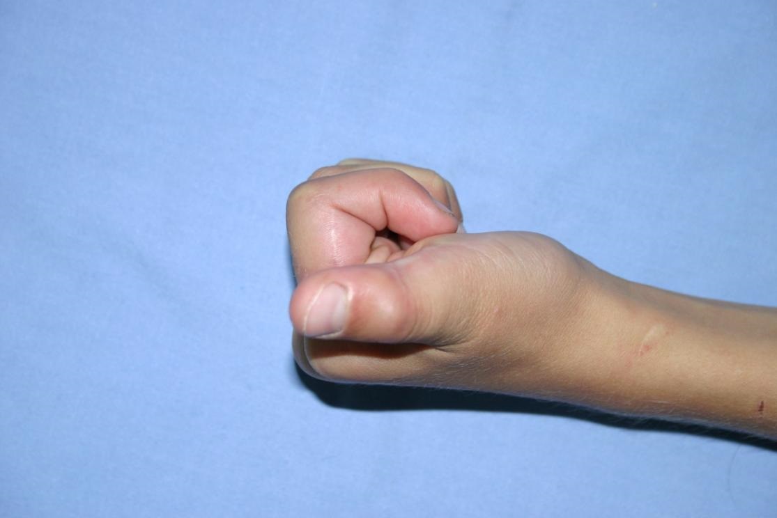 Bilde nr. 7. replantēto pirkstu fleksija 3 mēnešus.