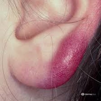 Boreliālā limfocitoma uz kreisās auss ļipiņas