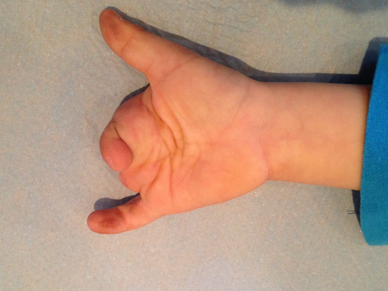 Funkcionālais rezultāts 2 gadus pēc pirksta transplantācijas