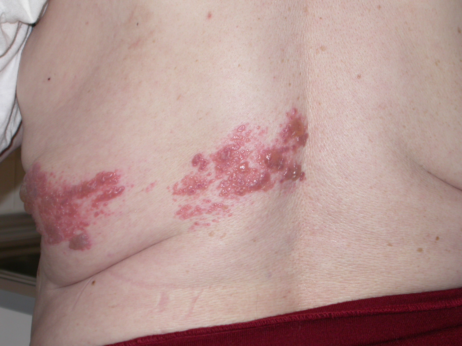 Herpes infekcija. Jostas roze.jpg