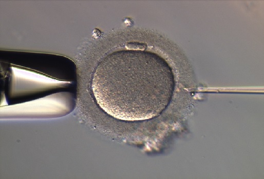 ISCI- spermatozoīda injicēšana olšūnā