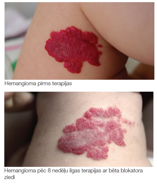 Hemangioma pirms un pēc terapijas
