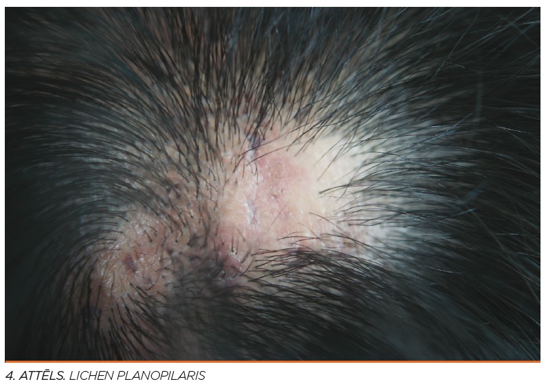 Lichen planopilaris- rētojoša matu izkrišana
