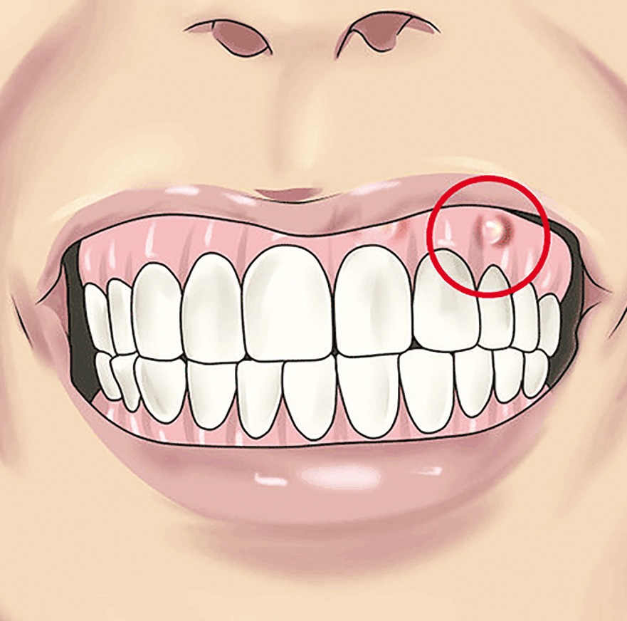 Lokāls zoba abscess