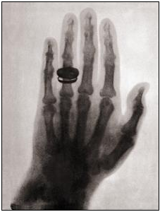 Pasaules pirmā rentgenogramma (pirms un pēc digitālās apstrādes)