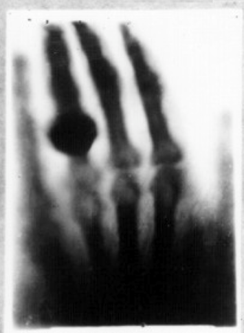 Pasaules pirmā rentgenogramma (pirms un pēc digitālās apstrādes)