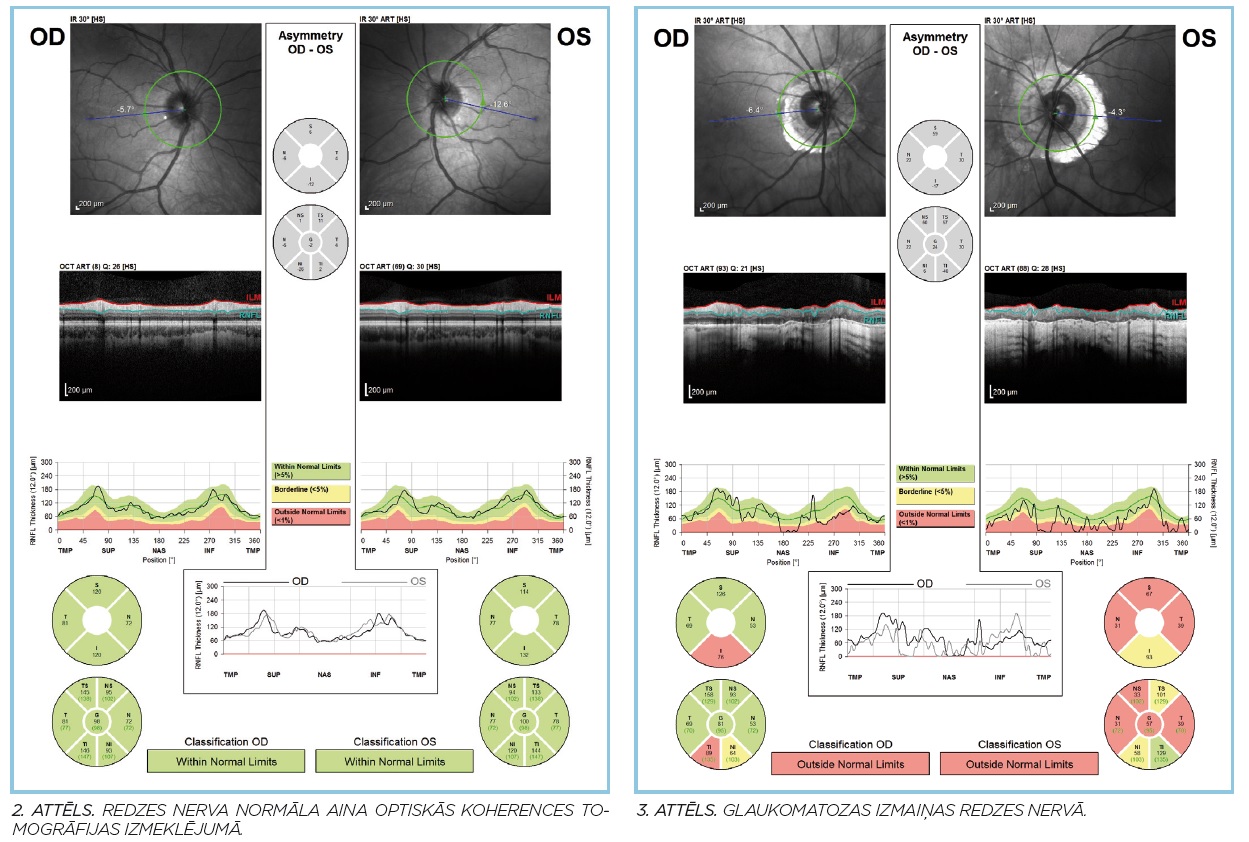 2. attēls Redzes nerva normāla aina optiskās koherences tomogrāfijas izmeklējumā.  3. attēls. Neglaukomatozas izmaiņas redzes nervā.) 