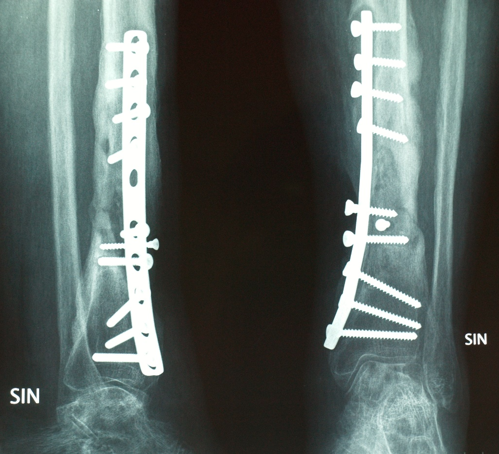 Rentgenoloģisks attēls, kurā redzams 4. tipa hronisks difūzs osteomielīts. 