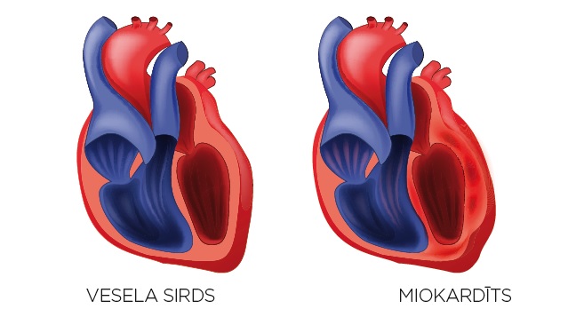 Vesela sirds un miokardīts