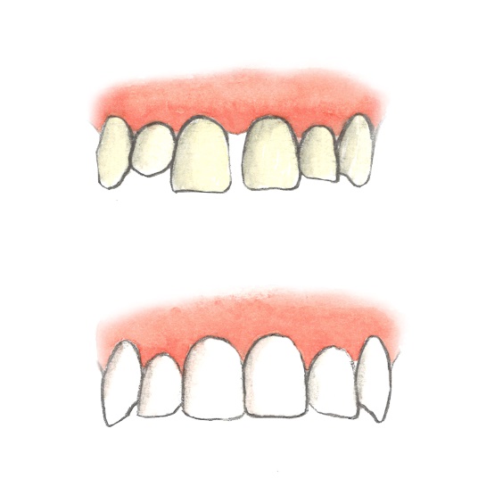 3. attēls. Zobu protezēšana ar porcelāna plāksnītēm