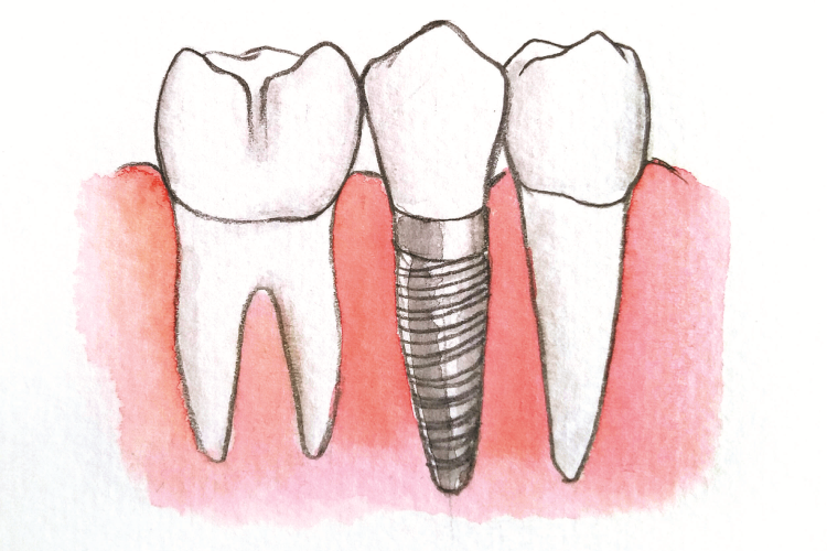 Zobu implants