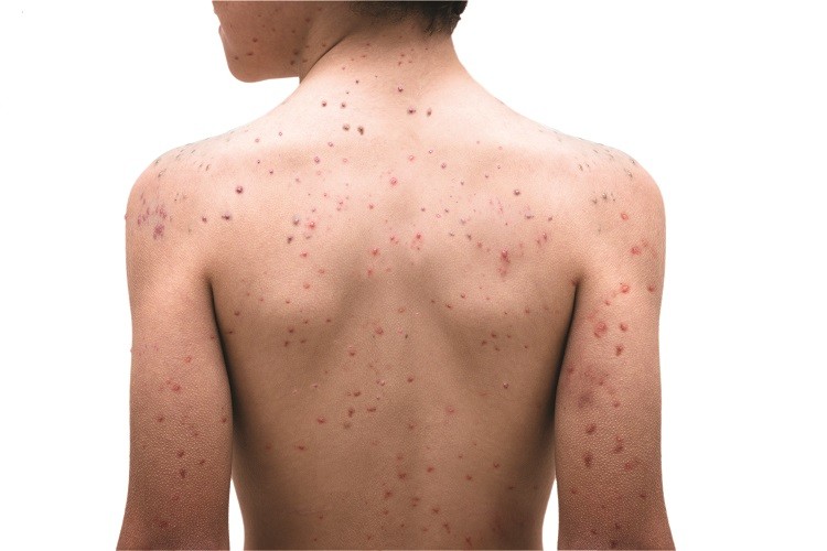 Raimonds Karls: Vīrusu izraisītās ādas slimības
