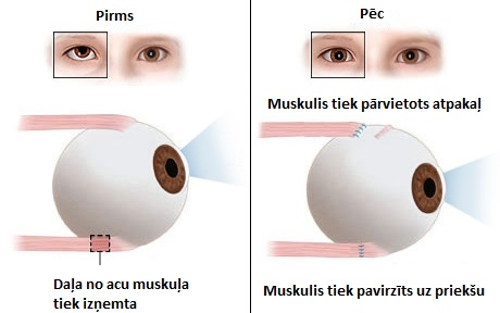 Šķielēšanas labošanas operācijas iedarbība uz acs ābola muskuļiem