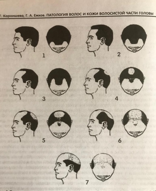 Androgēnas alopēcijas stadijas vīriešiem