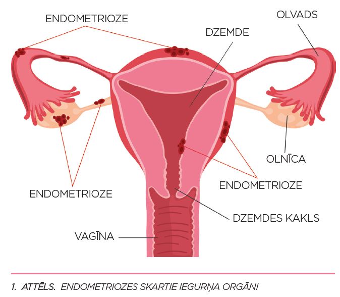 Endometrioze