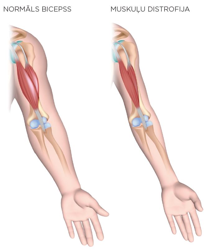 Normāls bicepss vs muskuļu distrofija