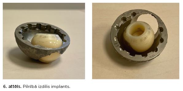 pilnībā izdilis implants