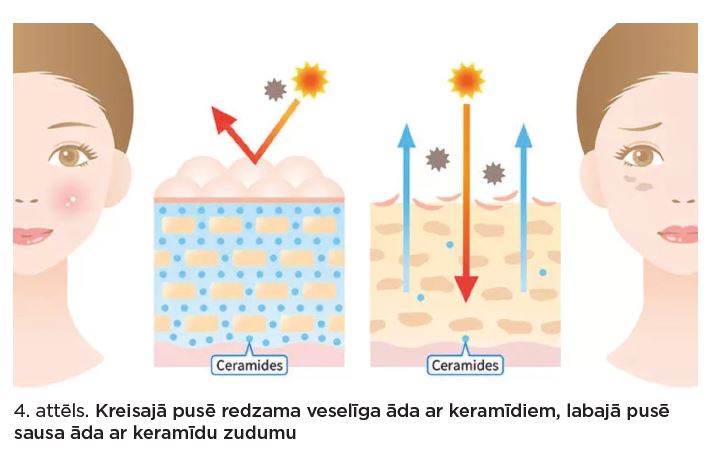 Kreisajā pusē redzama veselīga āda ar keramīdiem, labajā pusē sausa āda ar keramīdu zudumu