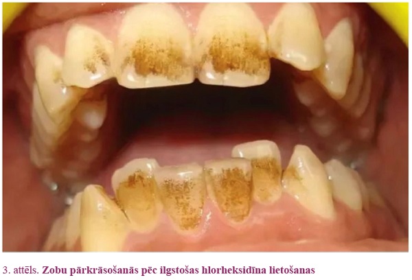 Zobu pārkrāsošanās pēc ilgstošas hlorheksidīna lietošanas