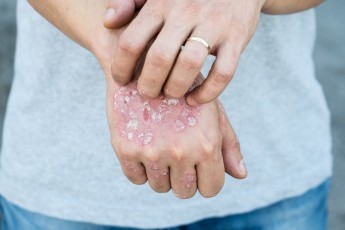 Lelde Reinberga, Ingmārs Mikažāns: Biežākās blakusslimības pacientam ar psoriāzi 