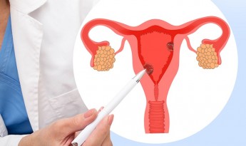 Laura Rācene: Endometrija polipi