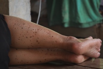 Laura Freiberga: Saule un pigmentācijas traucējumi 