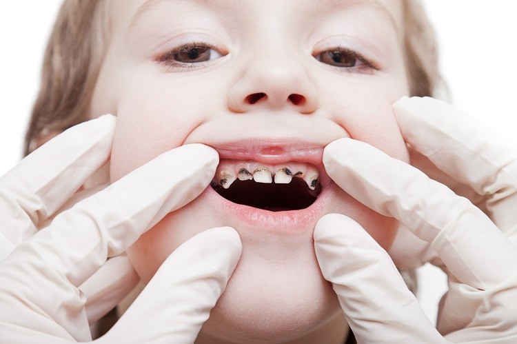 Māra Valdmane: Caurumi bērnu zobos? Kā no tiem izvairīties!