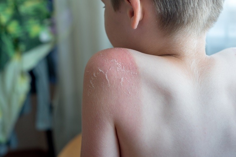 Jevgēnija Hmeļņicka: Ilglaicīgās ādas problēmas pēc saules apdeguma