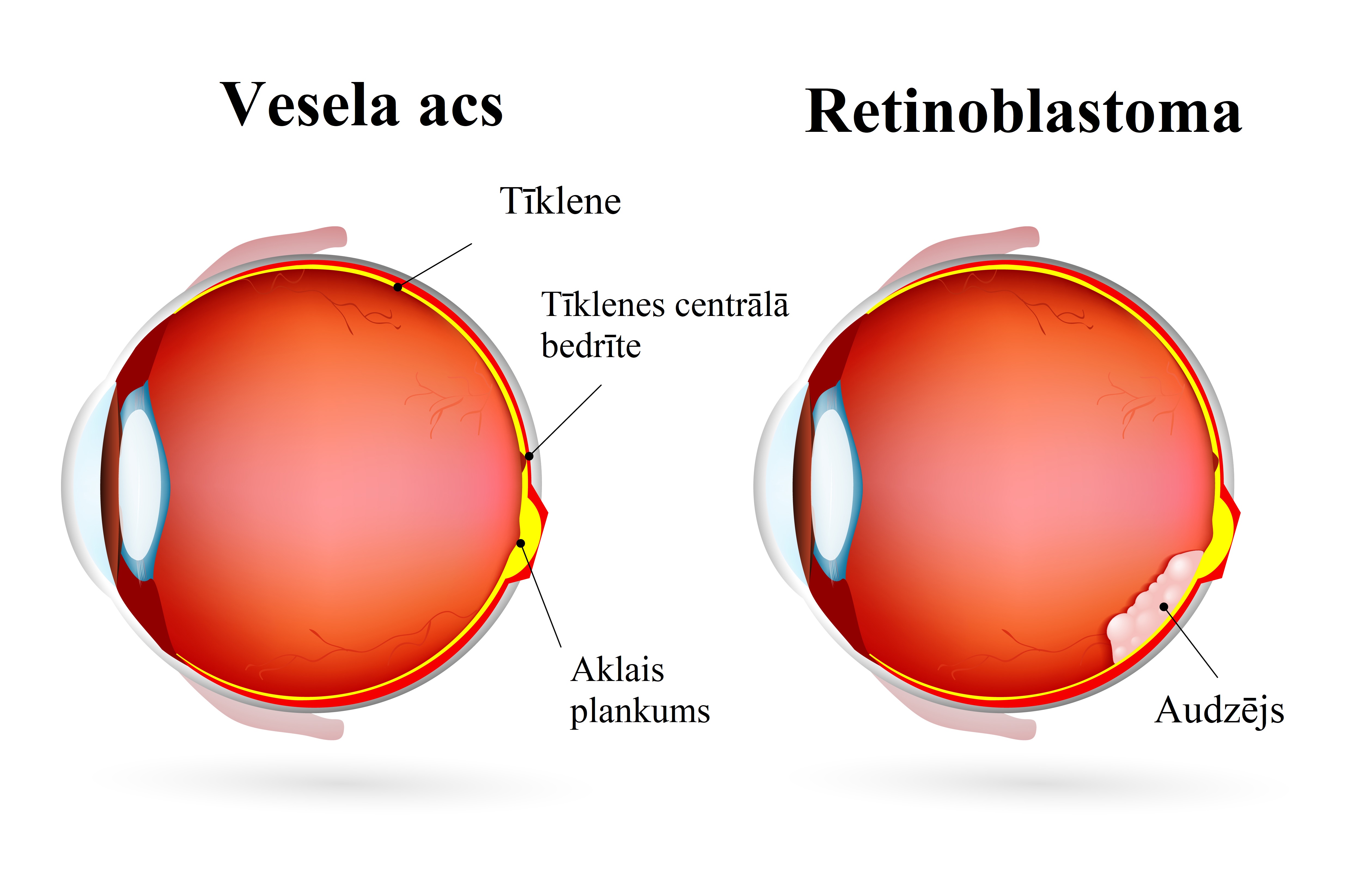 vesela acs un retinoblastoma