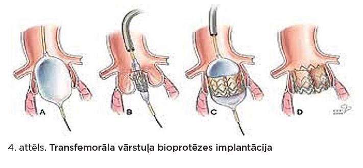 Transfemorālā vārstuļa bioprotēzes implantācija